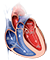 Valvular Heart Disease